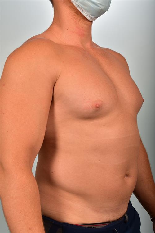 Male Breast/Areola Reduction Before Photo | Phoenix and Scottsdale, AZ | Scottsdale Center for Plastic Surgery