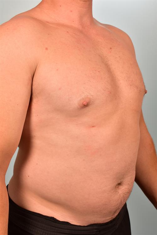 Male Breast/Areola Reduction After Photo | Phoenix and Scottsdale, AZ | Scottsdale Center for Plastic Surgery