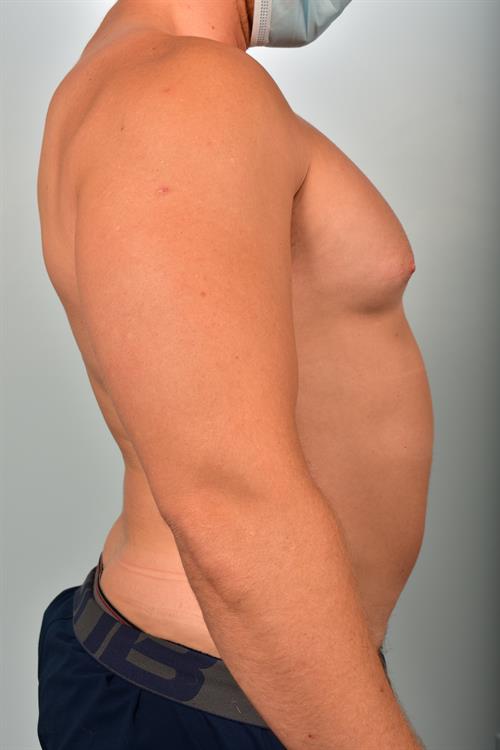 Male Breast/Areola Reduction Before Photo | Phoenix and Scottsdale, AZ | Scottsdale Center for Plastic Surgery