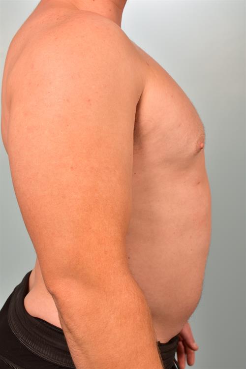 Male Breast/Areola Reduction After Photo | Phoenix and Scottsdale, AZ | Scottsdale Center for Plastic Surgery