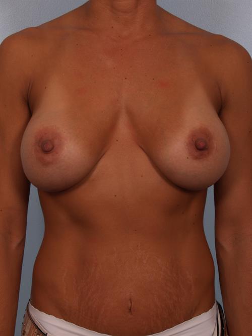 Breast Lift (Mastopexy) Before Photo | Phoenix and Scottsdale, AZ | Scottsdale Center for Plastic Surgery