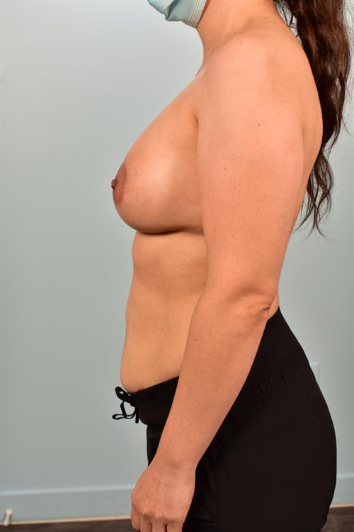Sub-Fascial Breast Augmentation After Photo | Phoenix and Scottsdale, AZ | Scottsdale Center for Plastic Surgery