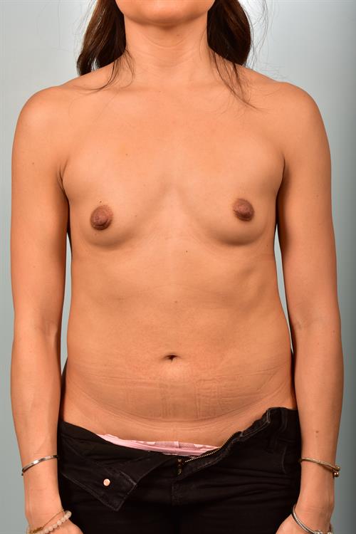 Breast Augmentation Before Photo | Paradise Valley, AZ | Scottsdale Center for Plastic Surgery