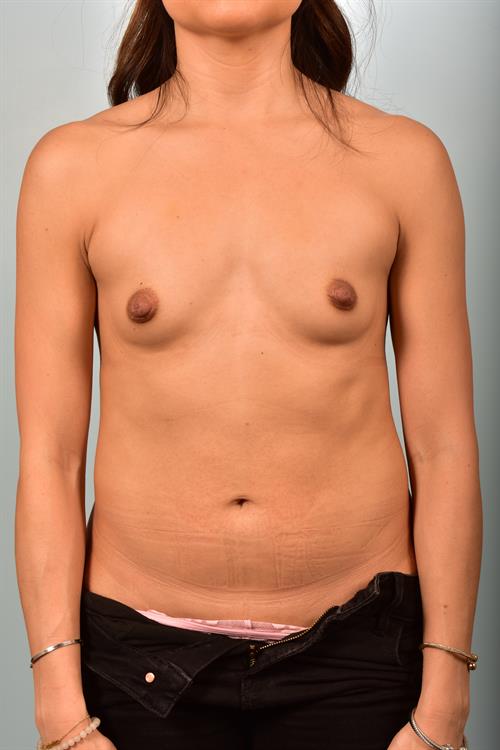 Breast Augmentation Before Photo | ,  | 