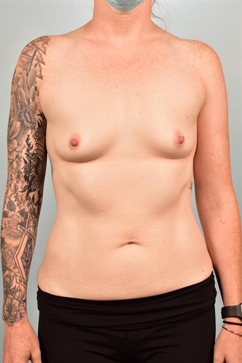 Sub-Fascial Breast Augmentation Before Photo | Phoenix and Scottsdale, AZ | Scottsdale Center for Plastic Surgery