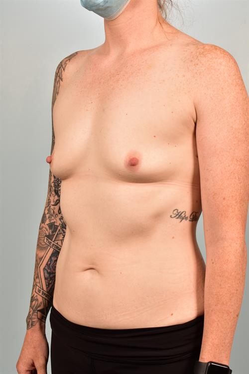 Sub-Fascial Breast Augmentation Before Photo | Phoenix and Scottsdale, AZ | Scottsdale Center for Plastic Surgery