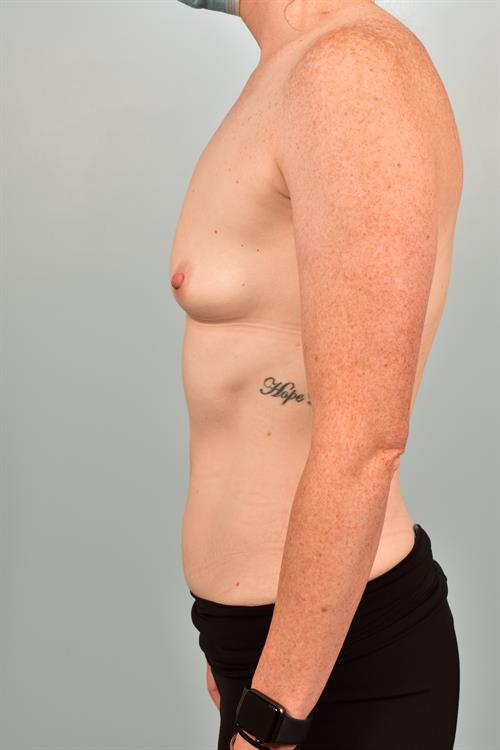 Sub-Fascial Breast Augmentation Before Photo | Phoenix and Scottsdale, AZ | Scottsdale Center for Plastic Surgery