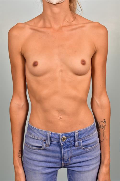 Breast Augmentation Before Photo | Phoenix and Scottsdale, AZ | Scottsdale Center for Plastic Surgery