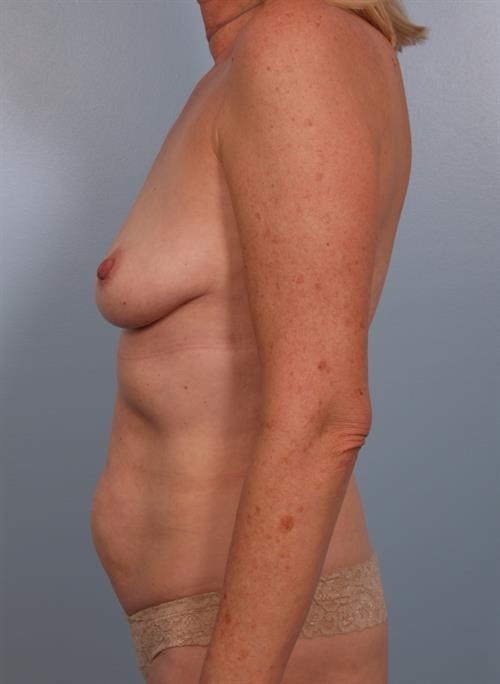 Mommy Makeover Before Photo | Phoenix and Scottsdale, AZ | Scottsdale Center for Plastic Surgery