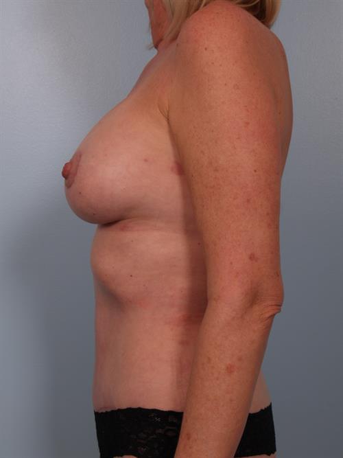 Mommy Makeover After Photo | Phoenix and Scottsdale, AZ | Scottsdale Center for Plastic Surgery