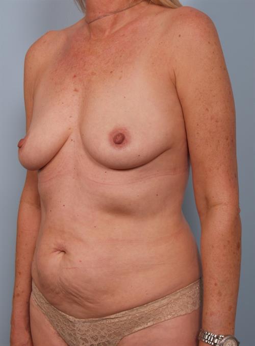 Mommy Makeover Before Photo | Phoenix and Scottsdale, AZ | Scottsdale Center for Plastic Surgery