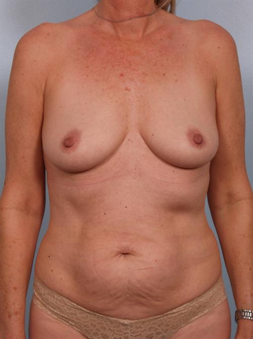 Mommy Makeover Before Photo | Phoenix and Scottsdale, AZ | Scottsdale Center for Plastic Surgery
