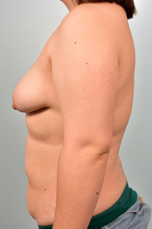 Tuberous Breast Surgery Before Photo | Phoenix and Scottsdale, AZ | Scottsdale Center for Plastic Surgery
