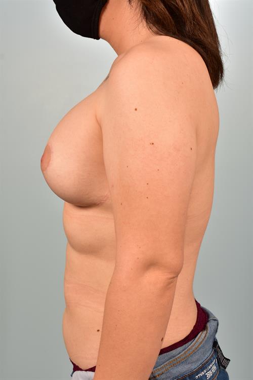 Tuberous Breast Surgery After Photo | Phoenix and Scottsdale, AZ | Scottsdale Center for Plastic Surgery