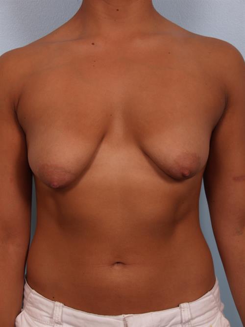 Tuberous Breast Surgery Before Photo | Phoenix and Scottsdale, AZ | Scottsdale Center for Plastic Surgery