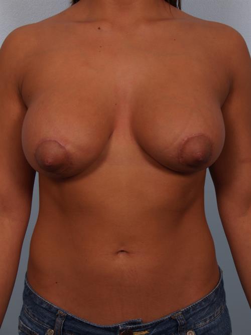 Tuberous Breast Surgery After Photo | Phoenix and Scottsdale, AZ | Scottsdale Center for Plastic Surgery