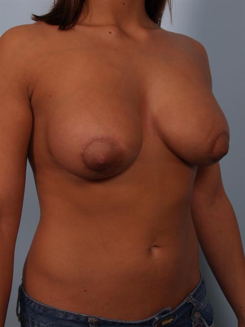Tuberous Breast Surgery After Photo | Phoenix and Scottsdale, AZ | Scottsdale Center for Plastic Surgery