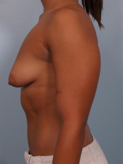 Tuberous Breast Surgery Before Photo | Phoenix and Scottsdale, AZ | Scottsdale Center for Plastic Surgery