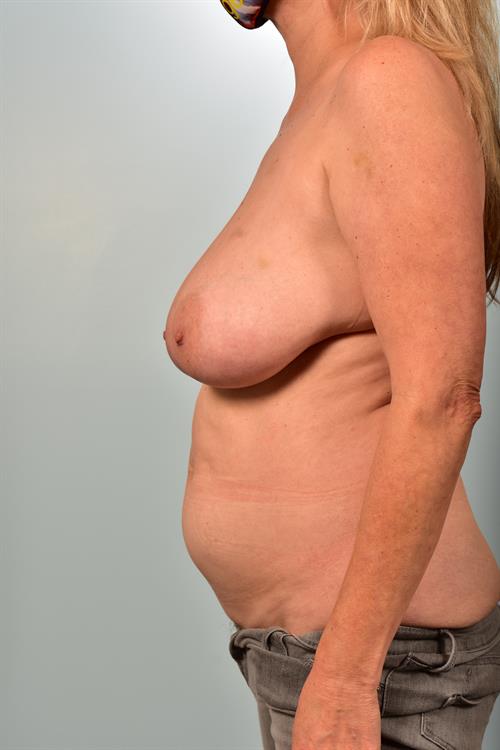Mommy Makeover Before Photo | Phoenix and Scottsdale, AZ | Scottsdale Center for Plastic Surgery