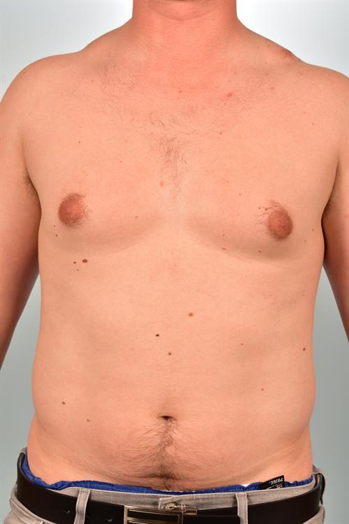 Male Breast/Areola Reduction Before Photo | Phoenix and Scottsdale, AZ | Scottsdale Center for Plastic Surgery