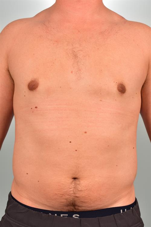 Male Breast/Areola Reduction After Photo | Phoenix and Scottsdale, AZ | Scottsdale Center for Plastic Surgery