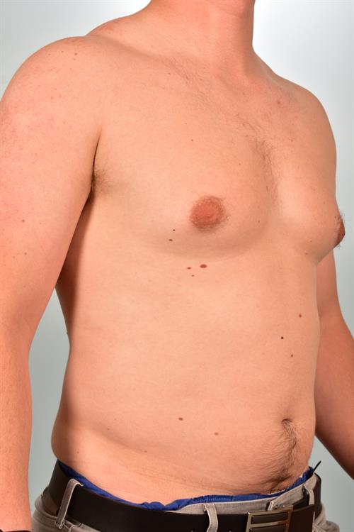 Male Breast/Areola Reduction Before Photo | Phoenix and Scottsdale, AZ | Scottsdale Center for Plastic Surgery