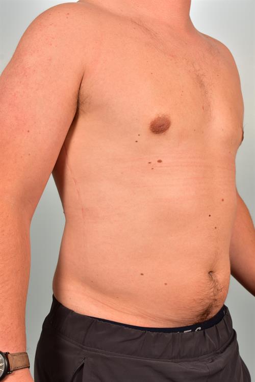 Male Breast/Areola Reduction After Photo | Phoenix and Scottsdale, AZ | Scottsdale Center for Plastic Surgery