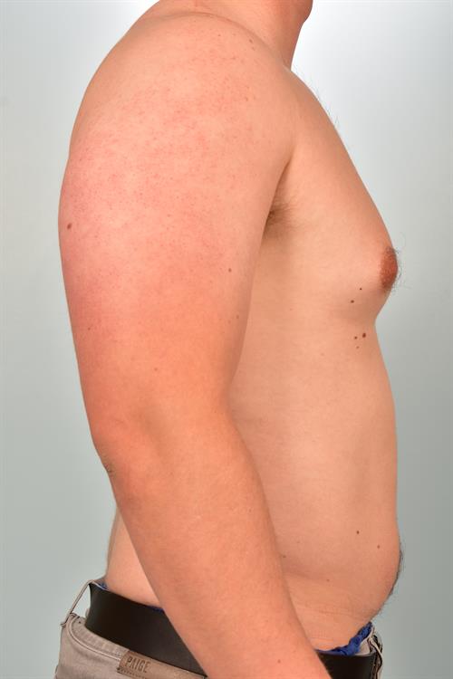 Male Breast/Areola Reduction Before Photo | Phoenix and Scottsdale, AZ | Scottsdale Center for Plastic Surgery