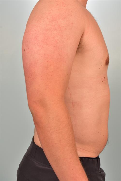 Male Breast/Areola Reduction After Photo | Phoenix and Scottsdale, AZ | Scottsdale Center for Plastic Surgery