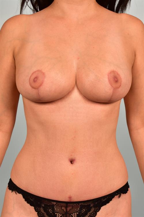 Breast Reduction After Photo | ,  | 