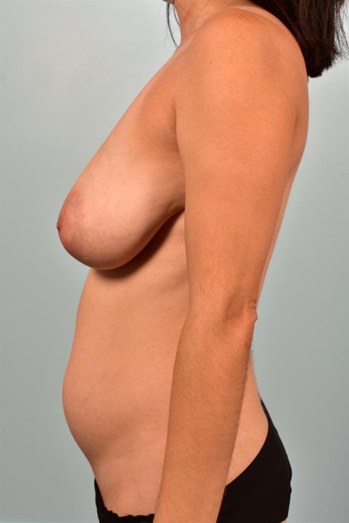 Breast Reduction Before Photo | ,  | 