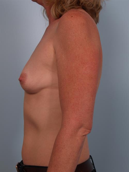 Breast Augmentation Before Photo | Phoenix and Scottsdale, AZ | Scottsdale Center for Plastic Surgery