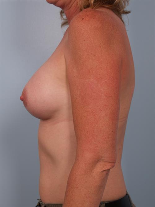 Breast Augmentation After Photo | Phoenix and Scottsdale, AZ | Scottsdale Center for Plastic Surgery