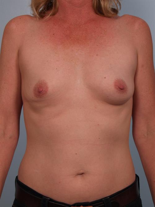 Breast Augmentation Before Photo | Phoenix and Scottsdale, AZ | Scottsdale Center for Plastic Surgery