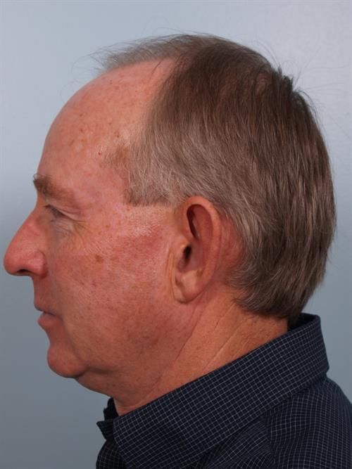 Otoplasty (Ear Reshaping) Before Photo | Phoenix and Scottsdale, AZ | Scottsdale Center for Plastic Surgery