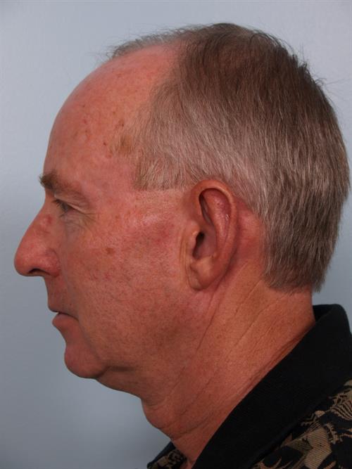 Otoplasty (Ear Reshaping) After Photo | Phoenix and Scottsdale, AZ | Scottsdale Center for Plastic Surgery