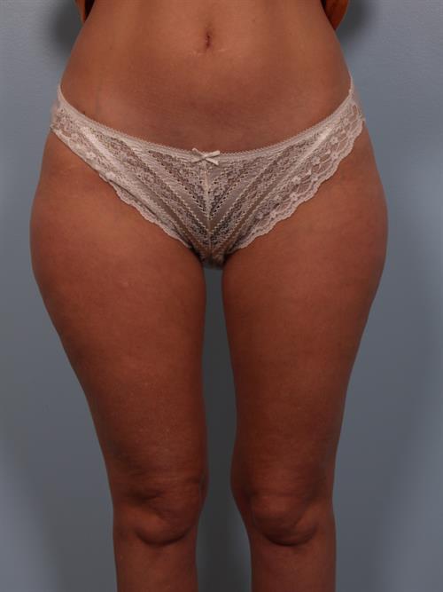 Power Assisted Liposuction Before Photo | Phoenix and Scottsdale, AZ | Scottsdale Center for Plastic Surgery