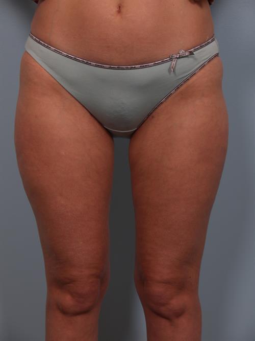 Power Assisted Liposuction After Photo | Phoenix and Scottsdale, AZ | Scottsdale Center for Plastic Surgery
