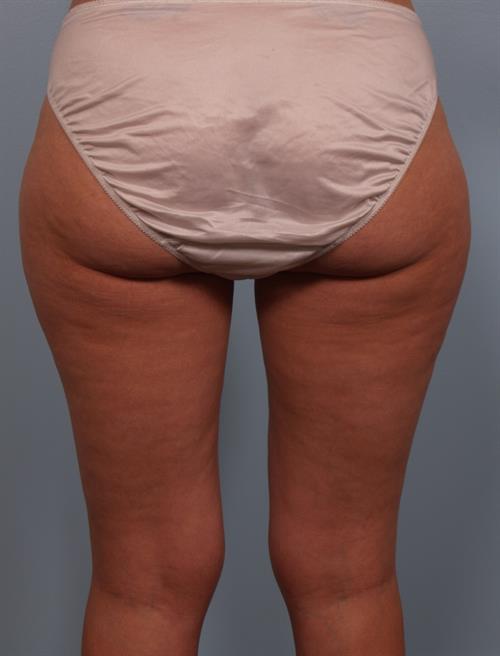 Power Assisted Liposuction Before Photo | Phoenix and Scottsdale, AZ | Scottsdale Center for Plastic Surgery