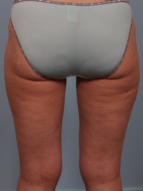 Power Assisted Liposuction After Photo | Phoenix and Scottsdale, AZ | Scottsdale Center for Plastic Surgery