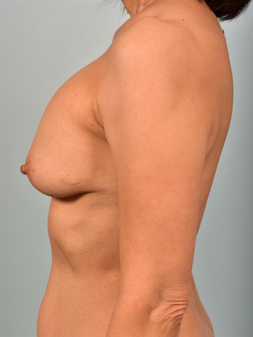Revision Breast Surgery Before Photo | Phoenix and Scottsdale, AZ | Scottsdale Center for Plastic Surgery