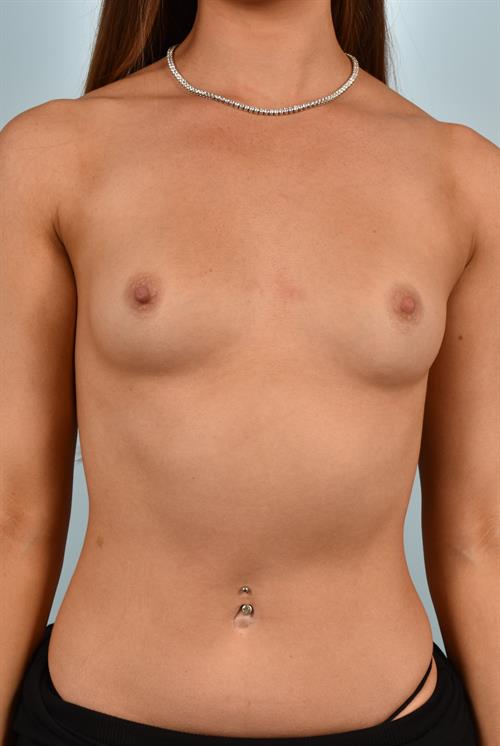 Sub-Fascial Breast Augmentation Before Photo | Phoenix and Scottsdale, AZ | Scottsdale Center for Plastic Surgery