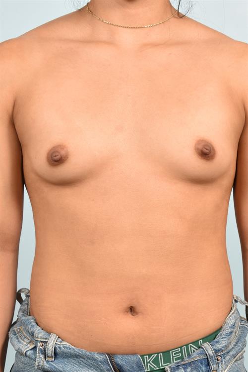 Sub-Fascial Breast Augmentation Before Photo | Phoenix and Scottsdale, AZ | Scottsdale Center for Plastic Surgery
