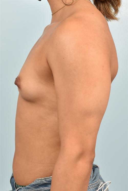 Sub-Fascial Breast Augmentation Before Photo | Phoenix and Scottsdale, AZ | Scottsdale Center for Plastic Surgery