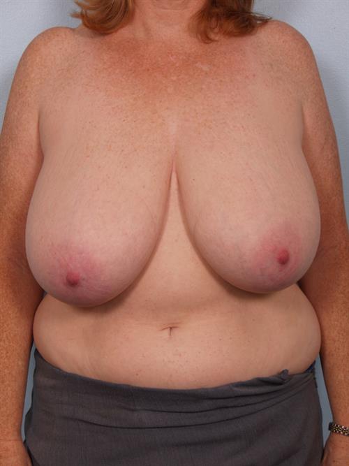 Breast Reduction Before Photo | Phoenix and Scottsdale, AZ | Scottsdale Center for Plastic Surgery