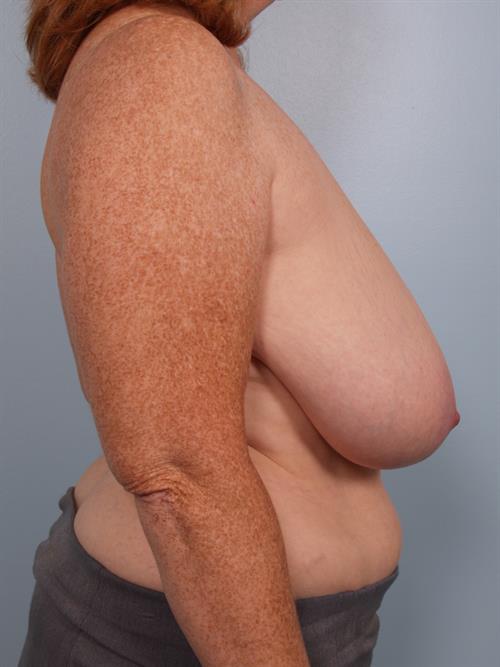 Breast Reduction Before Photo | Phoenix and Scottsdale, AZ | Scottsdale Center for Plastic Surgery