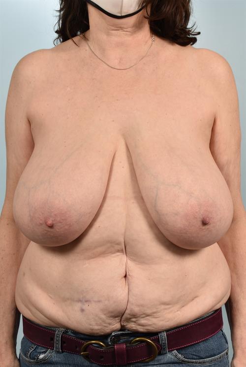 Breast Reduction Before Photo | Phoenix and Scottsdale, AZ | Scottsdale Center for Plastic Surgery