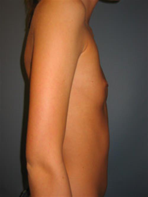 Breast Augmentation Before Photo | Phoenix and Scottsdale, AZ | Scottsdale Center for Plastic Surgery