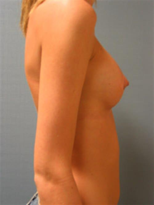 Breast Augmentation After Photo | Phoenix and Scottsdale, AZ | Scottsdale Center for Plastic Surgery