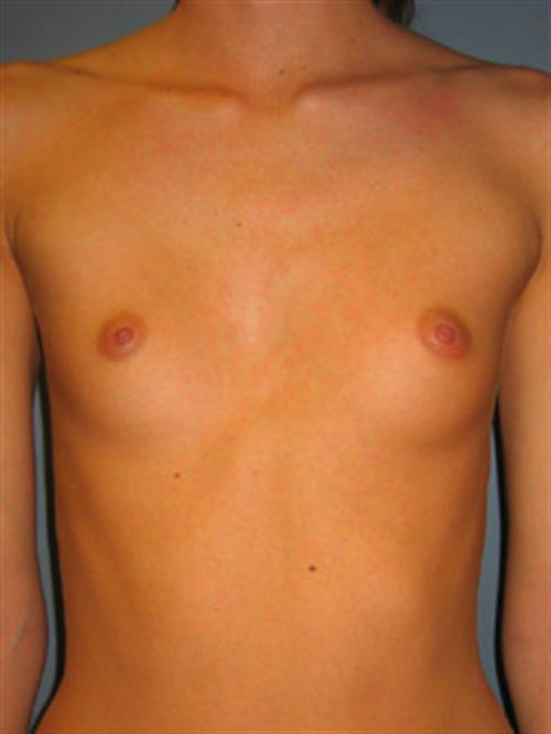 Breast Augmentation Before Photo | Phoenix and Scottsdale, AZ | Scottsdale Center for Plastic Surgery
